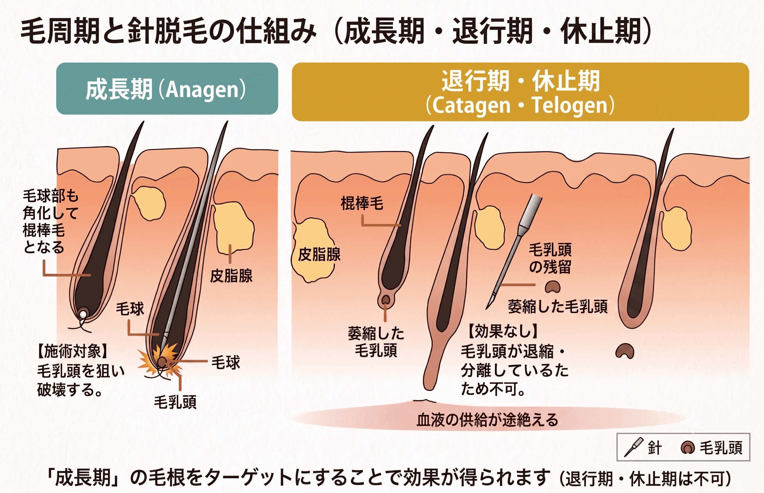 医療針脱毛(絶縁針脱毛、ニードル脱毛)