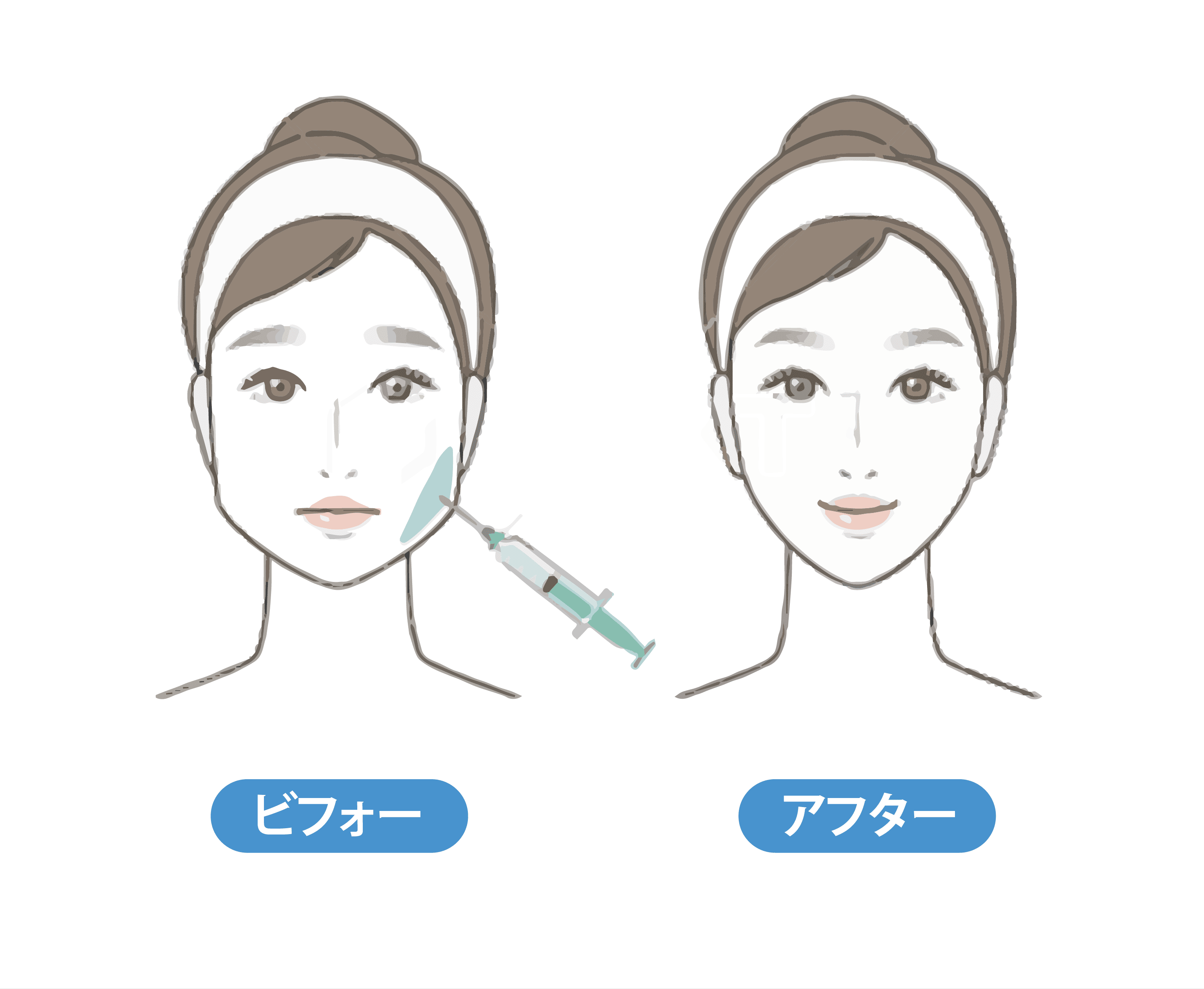 エラボトックス症例イメージ画像