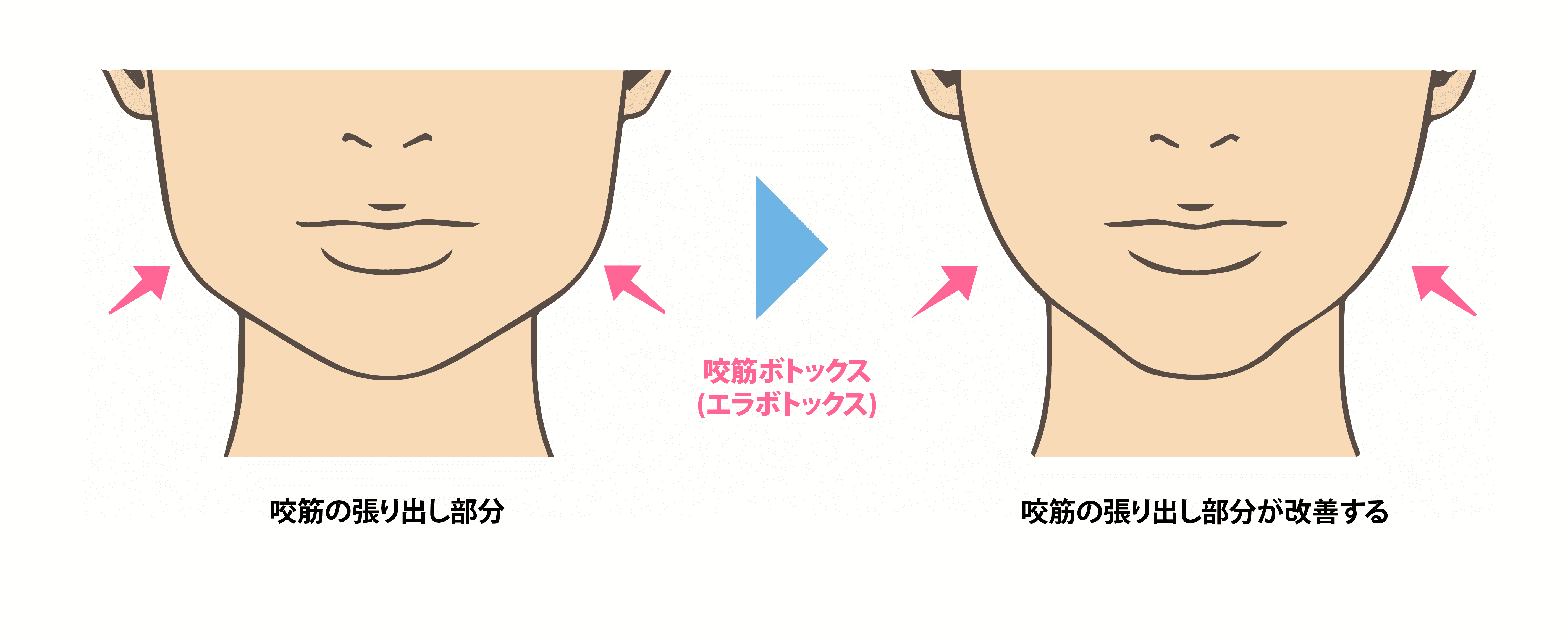 エラボトックスの効果説明