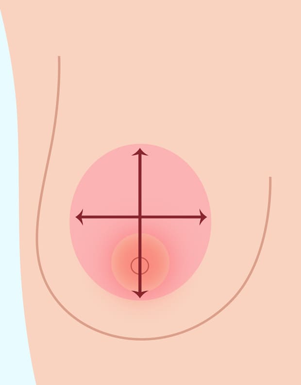 乳輪周囲切開法